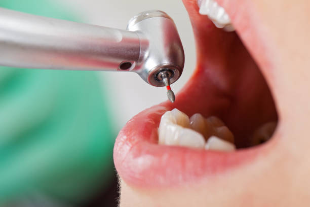Best Dental Abscess Treatment in Madison, MS